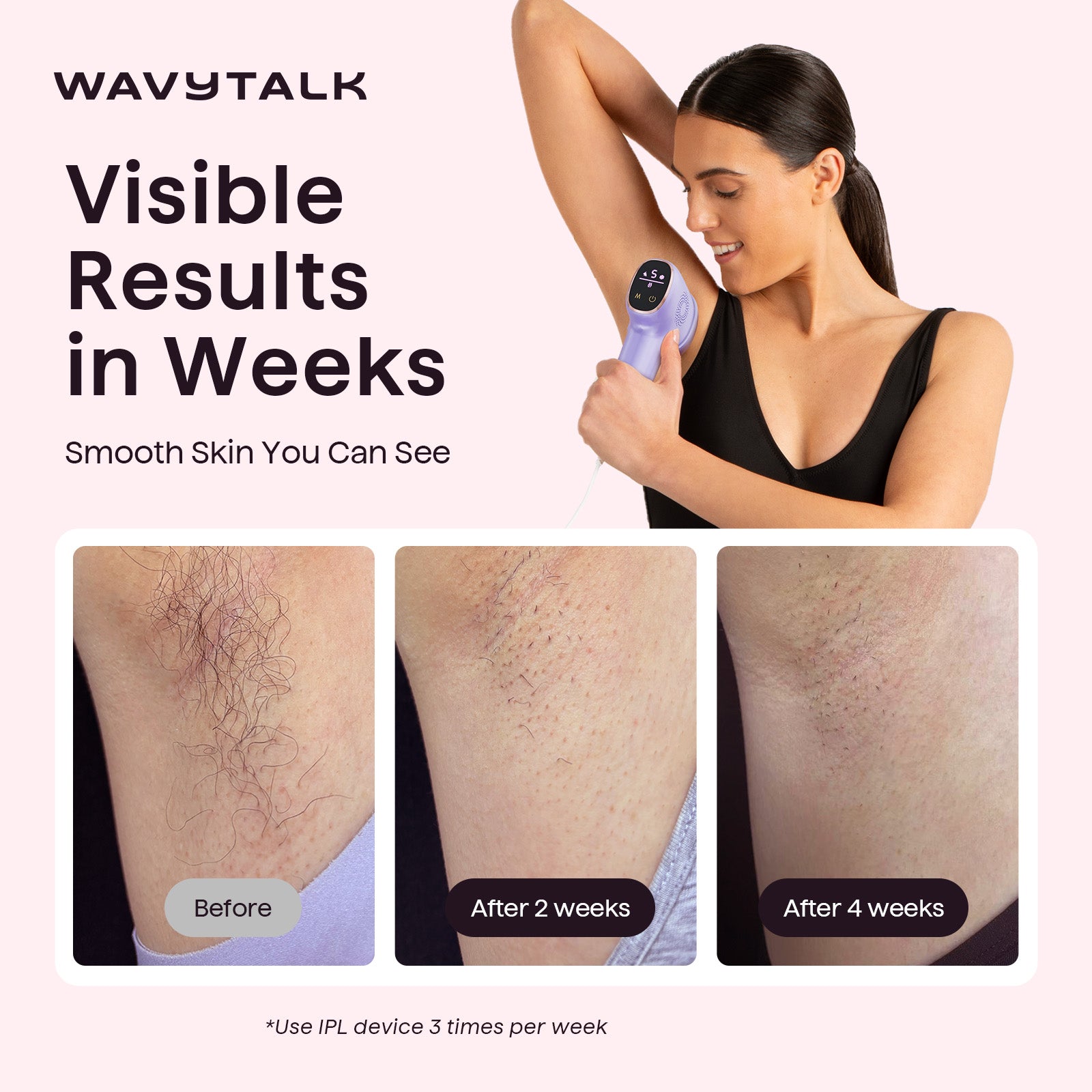 Woman using Wavytalk IPL device with before and after results on skin.