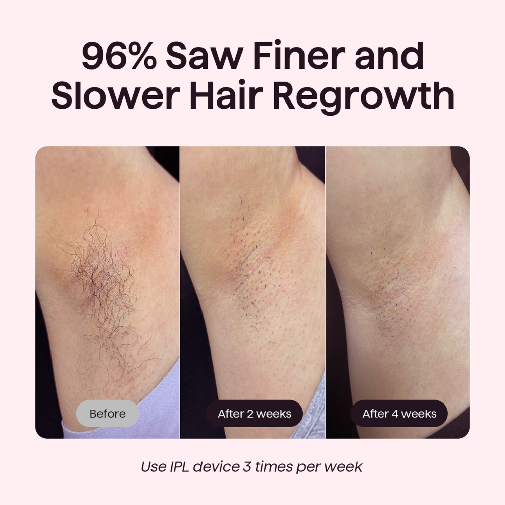 Before and after hair regrowth treatment showing finer and slower hair growth on a person's leg.